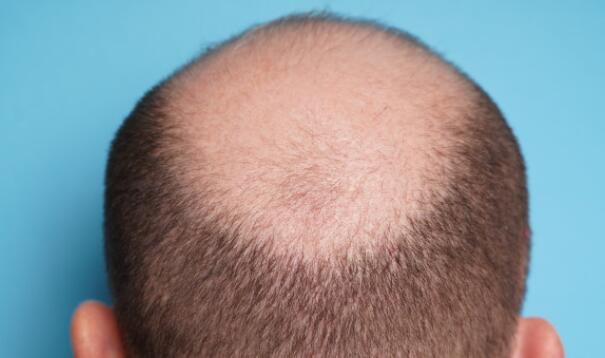 Focus on your hair loss before it’s too late