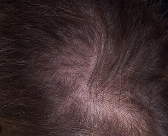 Comparison of copper peptide GHK-CU with Minoxidil in the treatment of alopecia hair grow